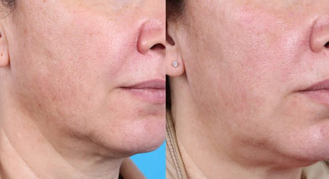 How Does PRP Treatment Rejuvenate Your Face